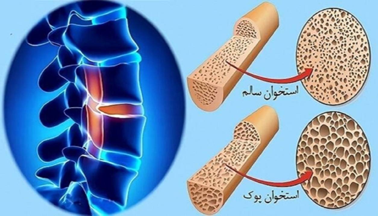 پوکی استخوان از دهه چهارم زندگی شروع می‌شود