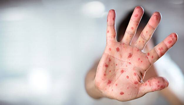 ابتلای ۲۹ نفر به بیماری سرخک در بابل