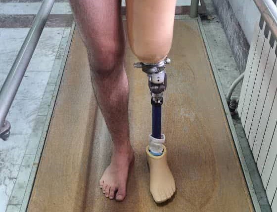 ساخت نخستین پروتز بالای زانو با لاینر سیلیکونی قفل‌دار در مازندران