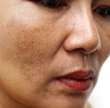 نسخه طلایی رفع تیرگی پوست!