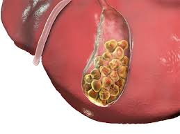 بهترین مسکن که درد سنگ کیسه صفرا  را از بین می‌برد