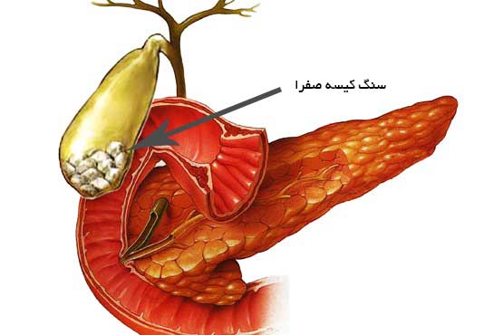 غذای فوق العاده‌ای که سنگ کیسه صفرا را دفع می‌کند