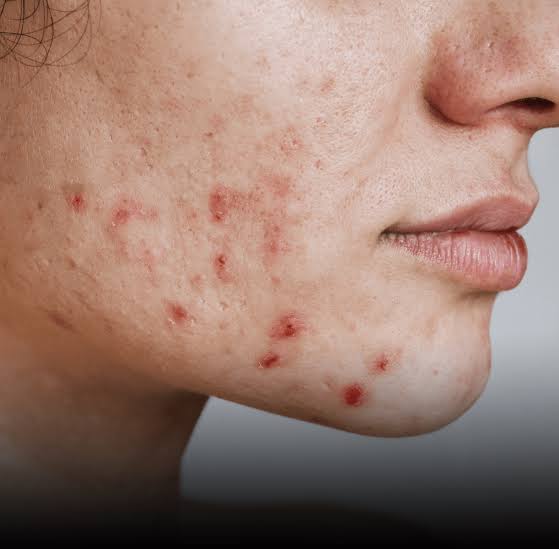 محلول ضد جوش!