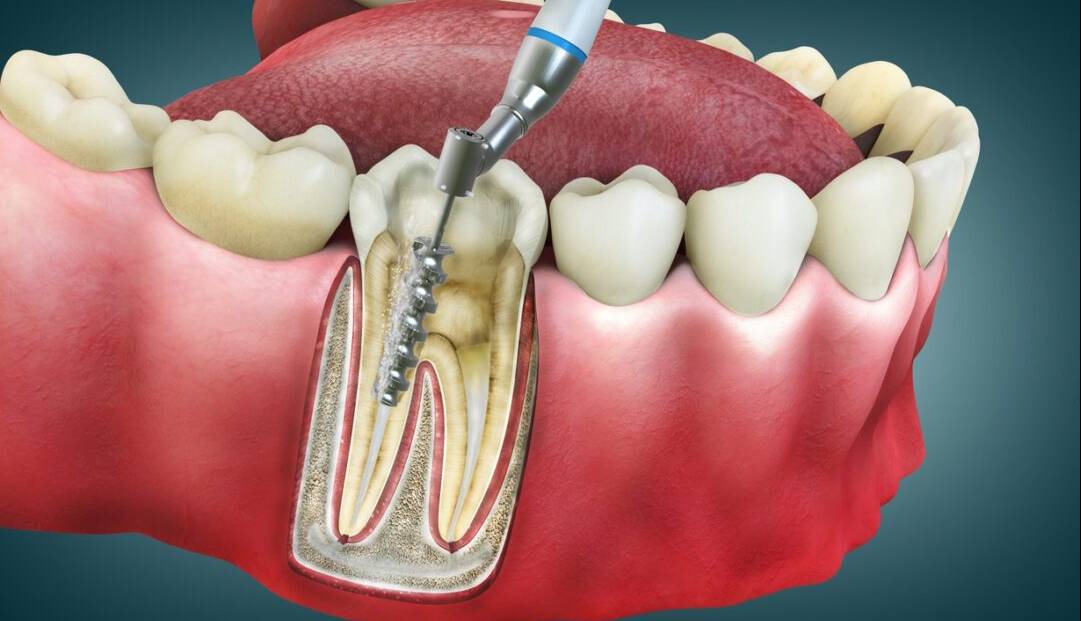 دیگر نمی‌خواهد دندان‌تان را پر کنید!