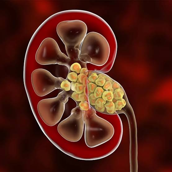 بهترین مواد غذایی برای افرادی که سنگ کلیه دارند
