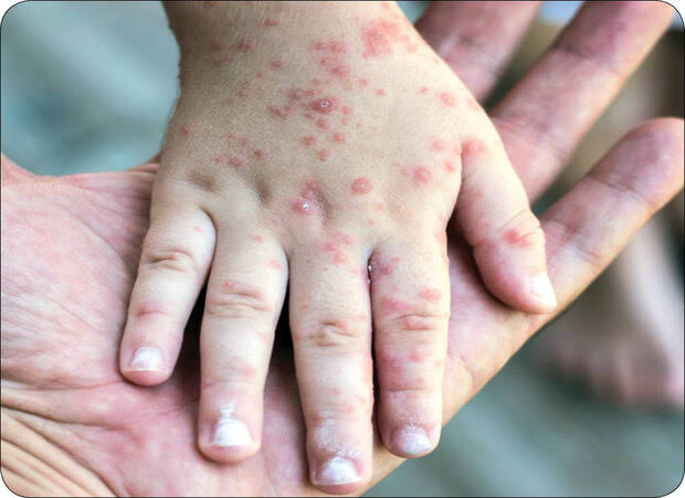 هشدار سازمان جهانی بهداشت؛ شیوع جهانی سرخک با سرعت