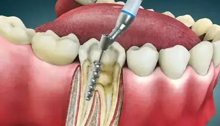 بعد از عصب‌کشی عفونت برمی‌گردد؟!